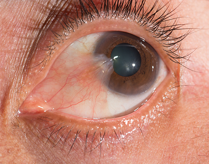 close up of the pterygium