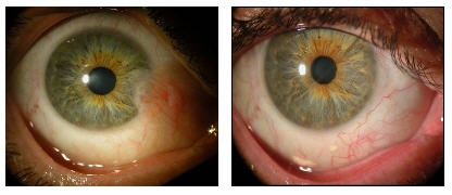 Before and After Pterygium Surgery