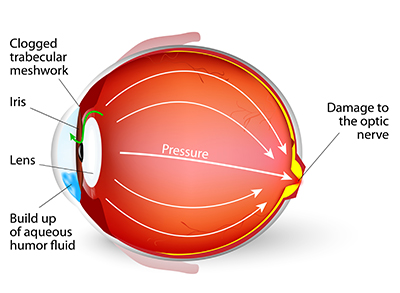 Diagram of Pressure on the Optic Nerve